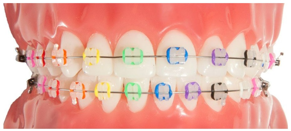 How Orthodontic Braces Work - Kyger Orthodontics BlogKyger Orthodontics Blog